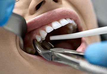 A closeup of a woman receiving a tooth extraction